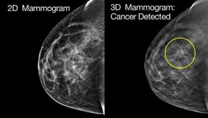 Маммография 3D